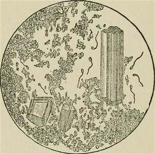 Infertility After D and C