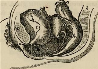 Infertility in Definition