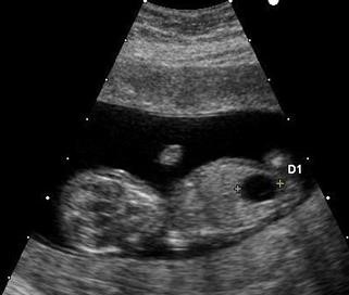 Unexplained Infertility Randomized Trial