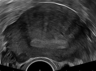 Nhs Infertility Statistics