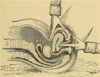 Infertility Mandate in Illinois