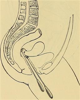 Immunological Causes of Female Infertility