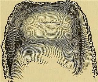 Endometriosis Scarring and Infertility