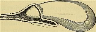 Arcuate Uterus Infertility Hysteroscopy