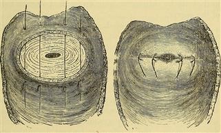 Infertility and Heart Disease