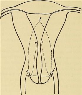 Infertility Not Covered by Insurance