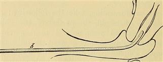 Female Infertility Causes Ovaries