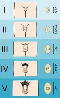 Stats on Infertility