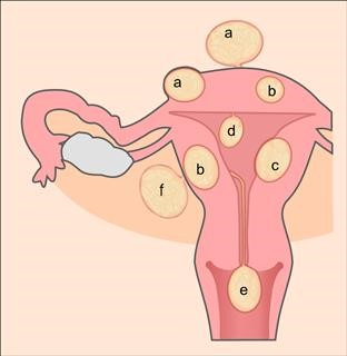 Infertility Royal Women's Hospital