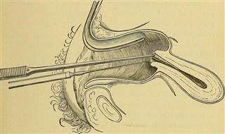 Infertility Hsg